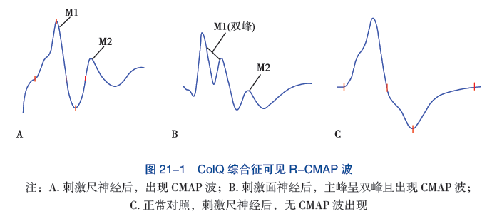图 21-1 CoIQ 综合征可见 R_CMAP 波