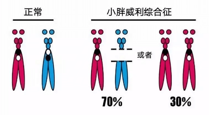 由于受孕过程中染色体表现异常，导致胎儿出生后15号染色体父源长臂表达缺陷，导致终生无法治愈的病症（但可通过综合性治疗，在一定程度上控制疾病的发展）